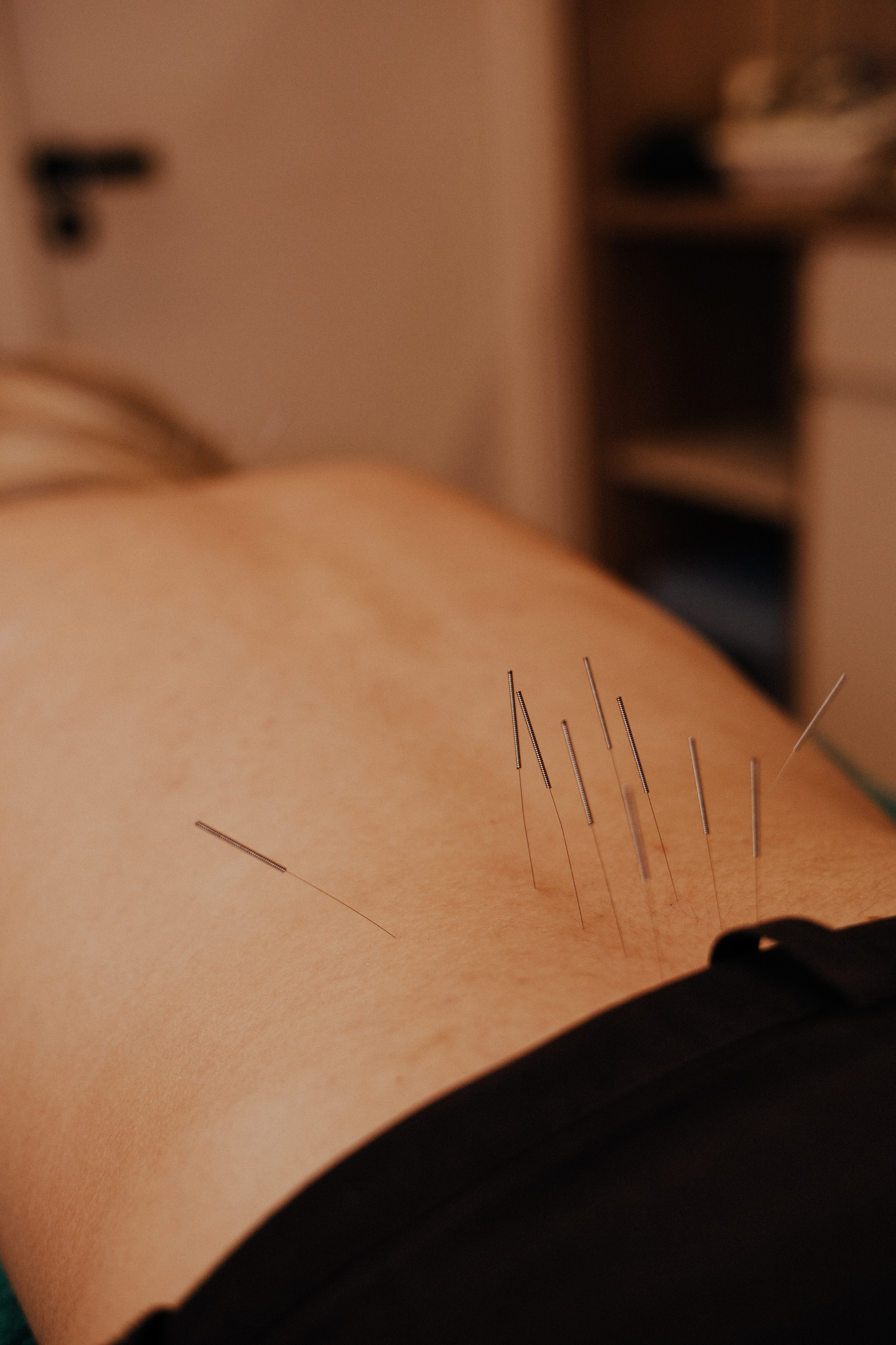 F&aacute;bio Pense em sess&atilde;o de acupuntura integrativa